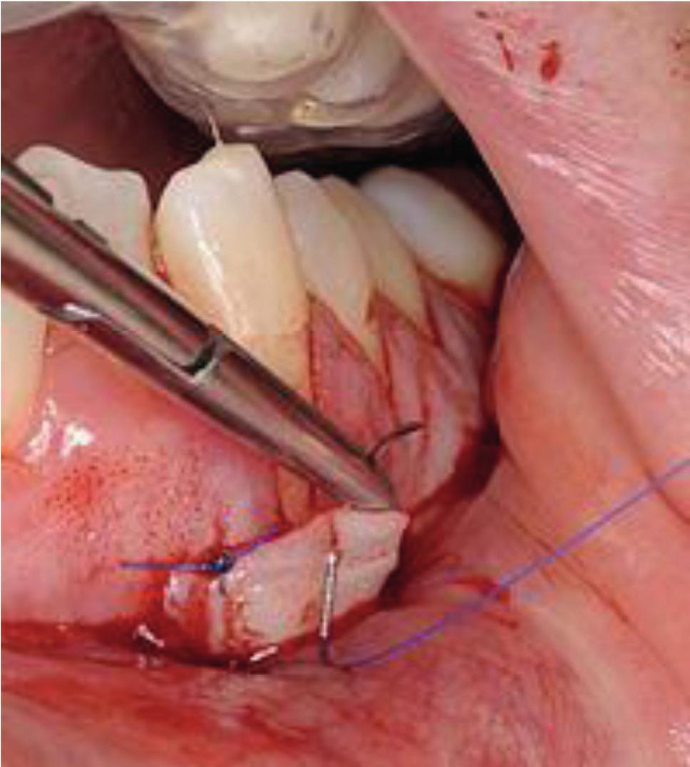CLINICAL cauterisation. A soft vacuum formed surgical stent containing a periodontal dressing is fitted to cover the palatal site and reduce discomfort during the post operative period (Figure 7).