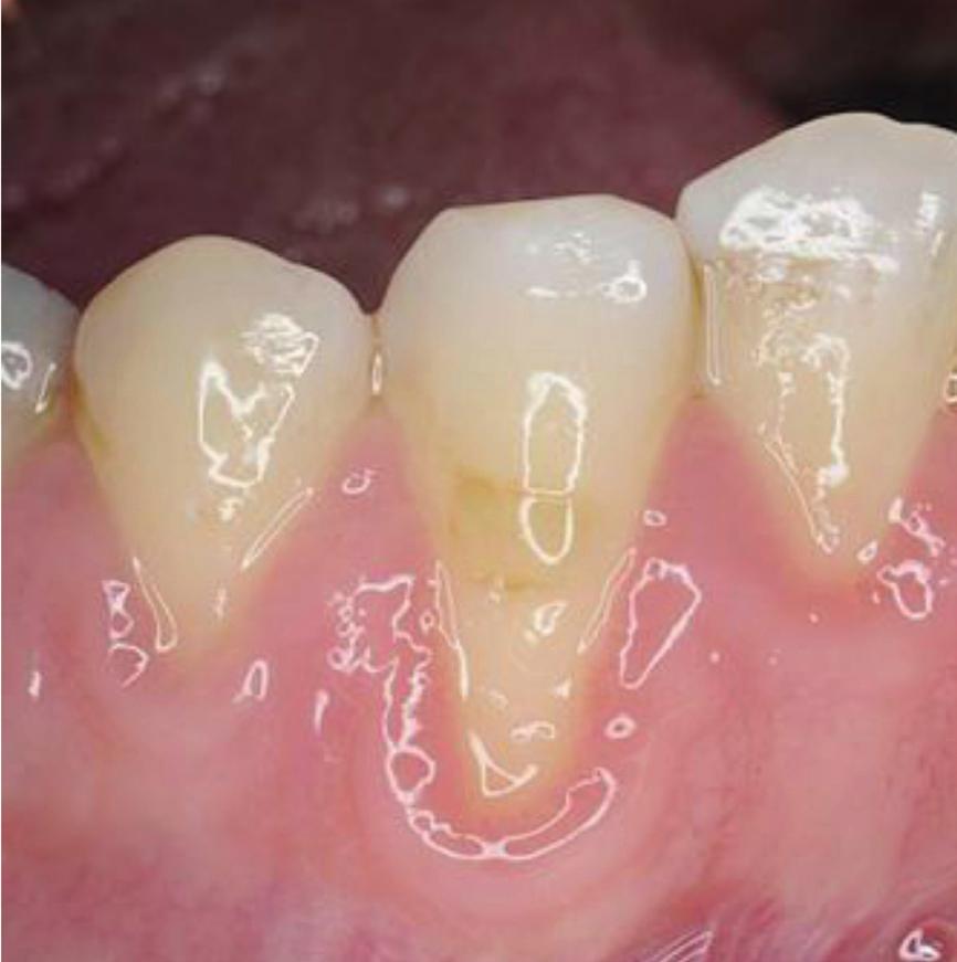Conclusion Gingival recession will continue to be a presenting complaint in a wide variety of patient populations.