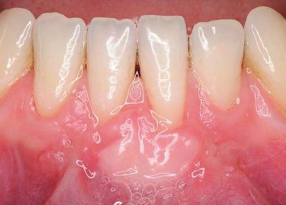 It is clear that certain recession defects in well motivated patients will benefit from free gingival grafting either to attempt root coverage or merely to increase the thickness of attached gingivae