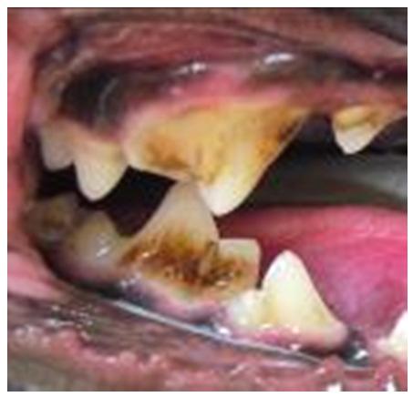 Four Stages of Periodontal Disease Gingivitis GRADE ONE Light brown tartar on teeth; no damaged