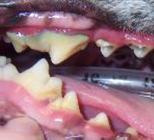 teeth; Extractions anticipated Advanced Periodontitis GRADE FOUR Heavy tartar & calculus