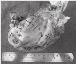 JINDAL et al. 2.2 Macroscopic Features A hemimandibulectomy was done under general anesthesia, and the resulting specimen was received for histopathologic examination.