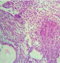 The hyperchromatic columnar cells from the epithelial lining showed luminal growth.