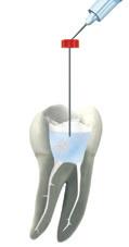 Preparation Step by Step Estimate or determine the root canal length depending on whether it is a narrow, medium or wide canal (see Electronic Length Determination on page 24). 1.