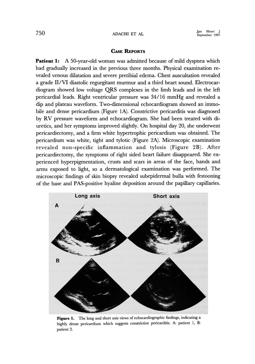 750 ADACHI ET AL Jpn Heart J September 1997 CASE REPORTS Patient 1: A 50-year-old woman was admitted because of mild dyspnea which had gradually increased in the previous three months.