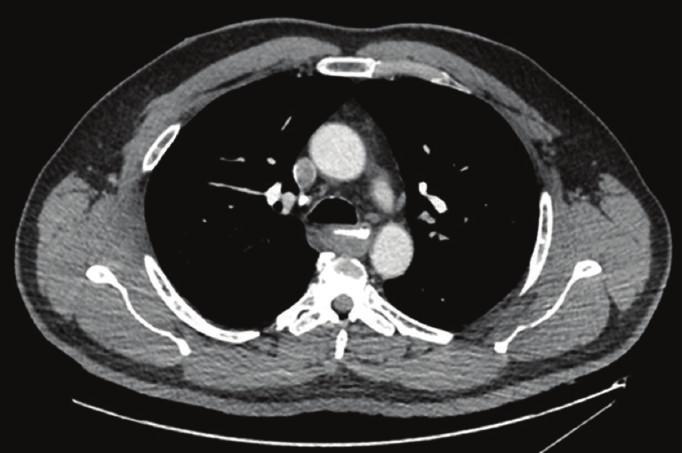 2 Case Reports in Surgery (a) (a) (b) (b) Figure 1: (a) CT scan of the chest, showing a well-circumscribed 5 cm submucosal esophageal