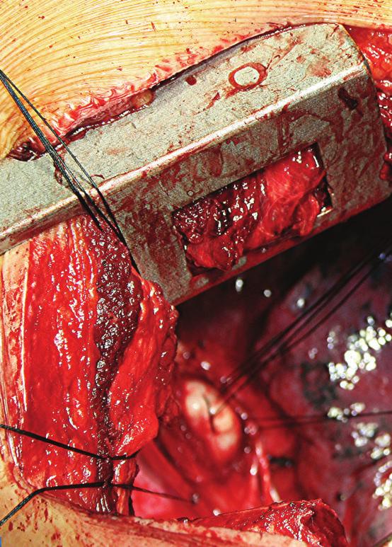 esophagus was repaired with vicryl 4-0 interrupted sutures and covered with parietal pleura.