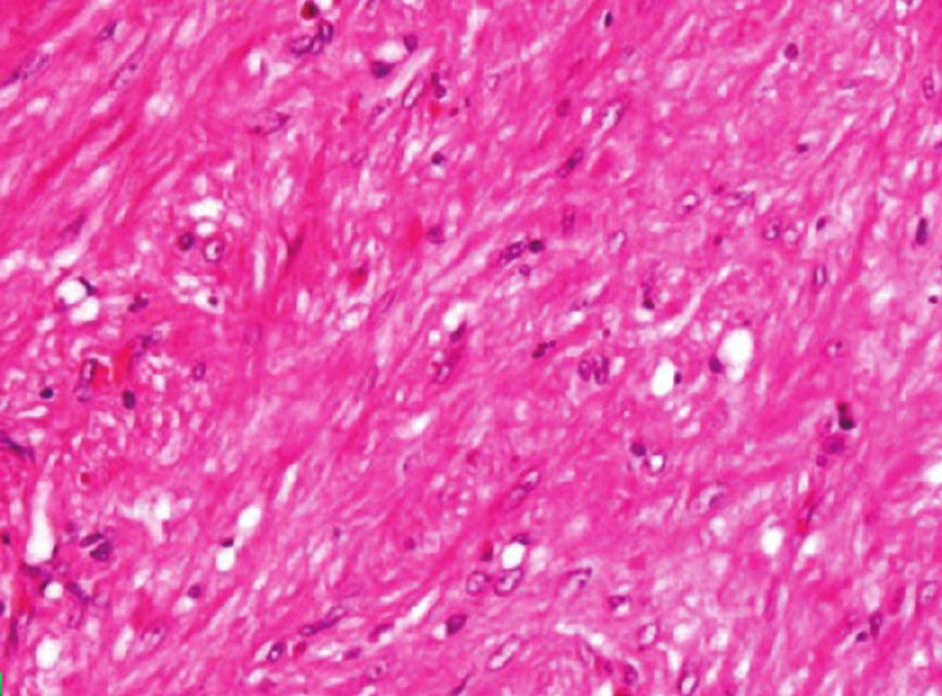 round and spindle cells (Figure 2(a)). No neoplastic cells were found to infiltrate the margins of the capsule.