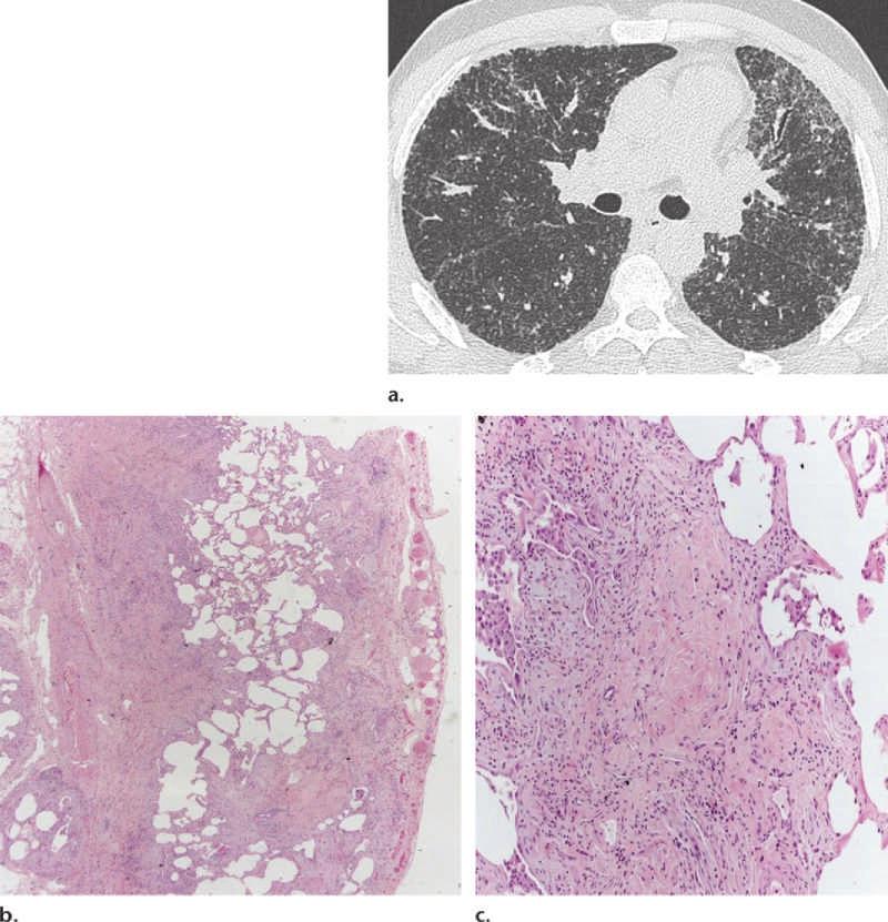 1858 November-December 2015 radiographics.rsna.org Figure 8. Fibrotic lung disease classified according to the IPF guidelines as a CT pattern inconsistent with UIP in a 37-year-old man.