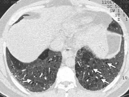 RG Volume 35 Number 7 Sverzellati et al 1861 4 years, whereas fine reticular elements, traction bronchiolectasis, and emphysema did not (79). Radiologic Differential Diagnosis. The CT fea- Figure 9.