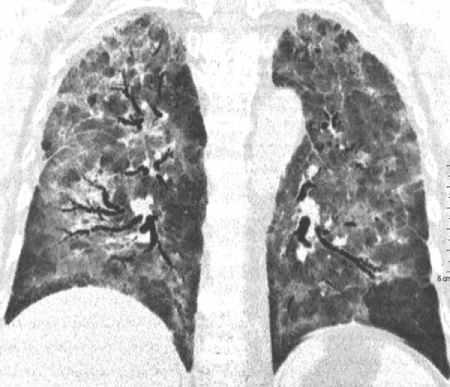 1864 November-December 2015 radiographics.rsna.org Figure 12. Acute interstitial pneumonia.