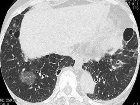 1866 November-December 2015 radiographics.rsna.org Figure 14. Lymphoid interstitial pneumonia.
