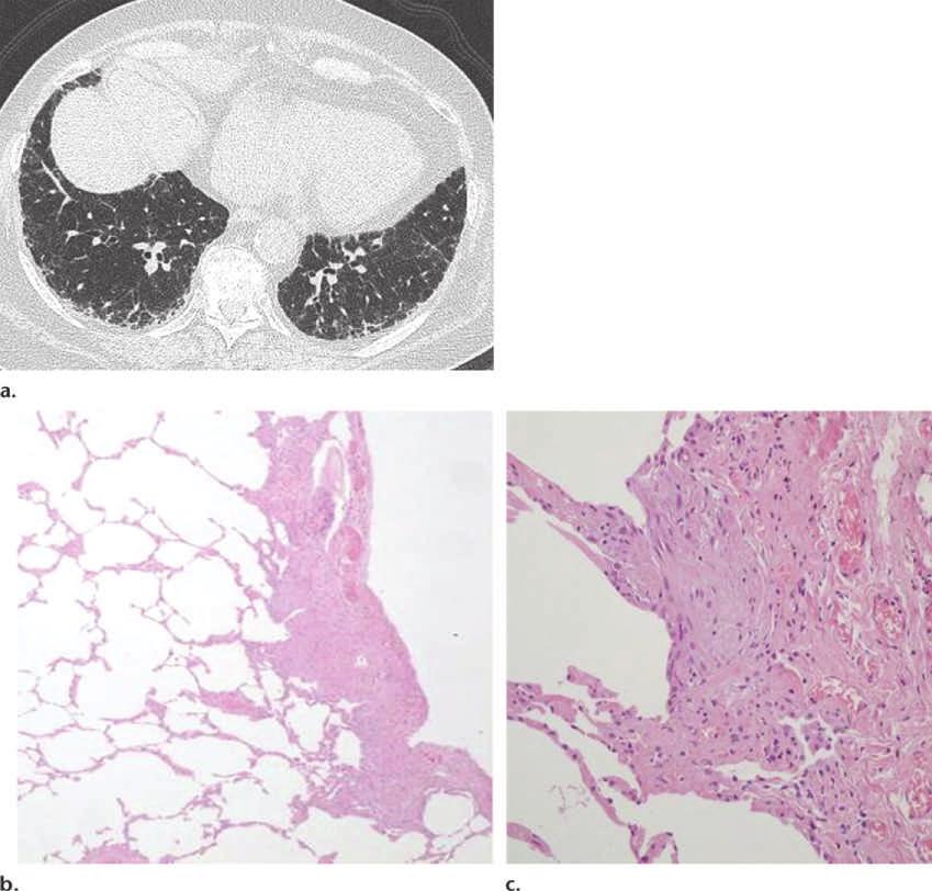 RG Volume 35 Number 7 Sverzellati et al 1857 Figure 7. Fibrotic lung disease classified according to the IPF guidelines as the possible UIP pattern in a 69-year-old man.
