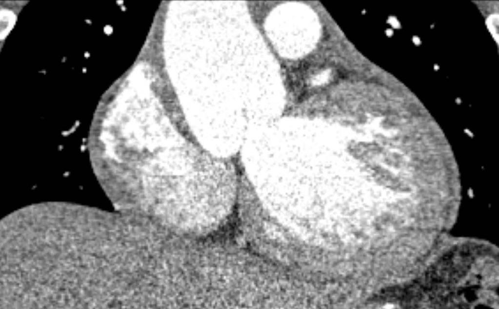 Figure 5: Dilated Aortic root