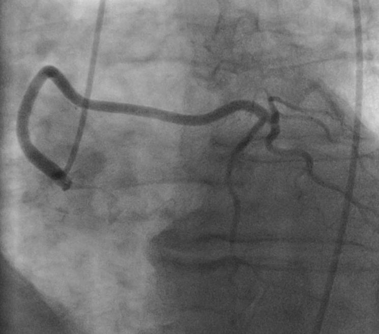 right main coronary artery on CTA