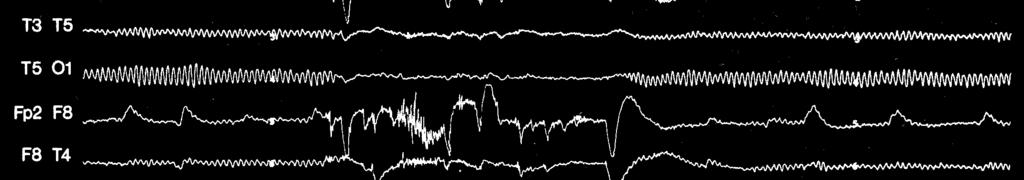 EEG interpreting Change
