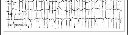 recorded from hippocampus delta rhythm: -under 3-4 Hz -Normal and dominant in 3 and 4 sleep stages and in infancy -Occurs in the cortex indep.
