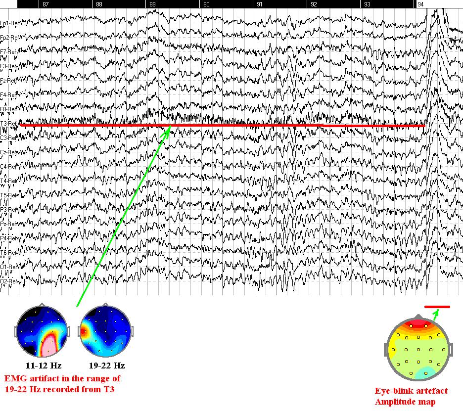 EMG and eye blink artifacts in EEG These types of artifacts can be detected by visual inspection.