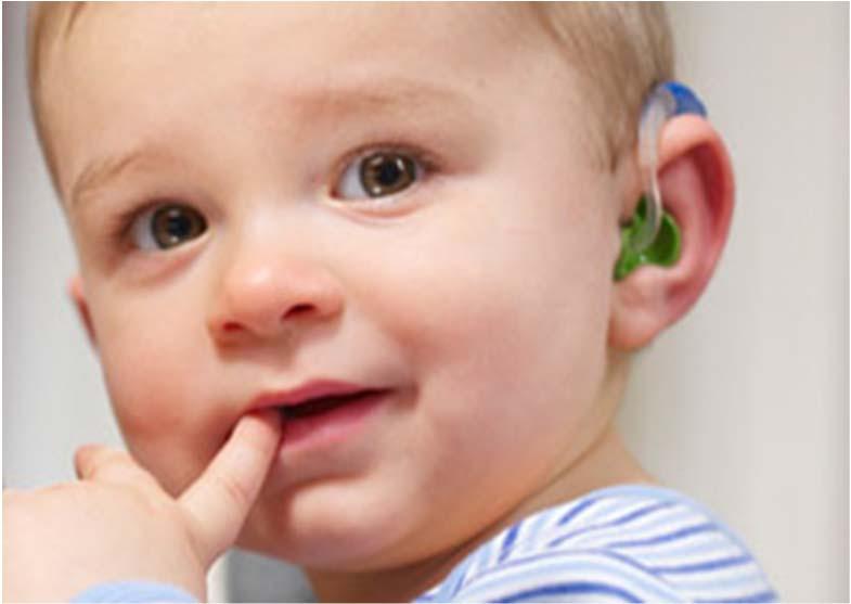HEARING LOSS Most Frequently Occurring Birth Defect 183 infants born