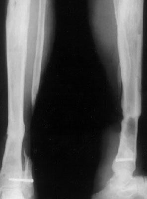 Ilizarov technique for circumferential skin defect anaesthetic. The radiographs at admission showed segmental bone loss of the tibia. (Figure 1).