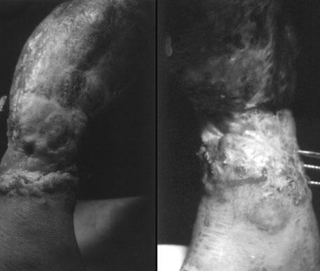 Figure 2 shows the final radiograph at the end of docking and lengthening. After 4 days of debridement, a partial thickness skin graft was applied over the soft tissue that was exposed.