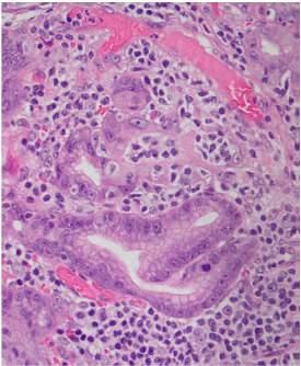 spreads to lymph nodes MALT lymphoma: Follicular colonization MALT lymphoma: Follicular