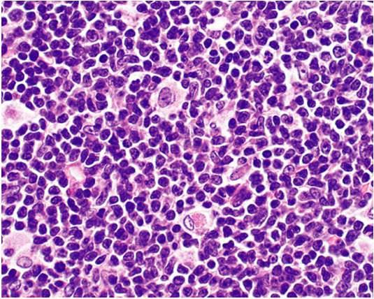 Mantle Cell Lymphoma Mantle