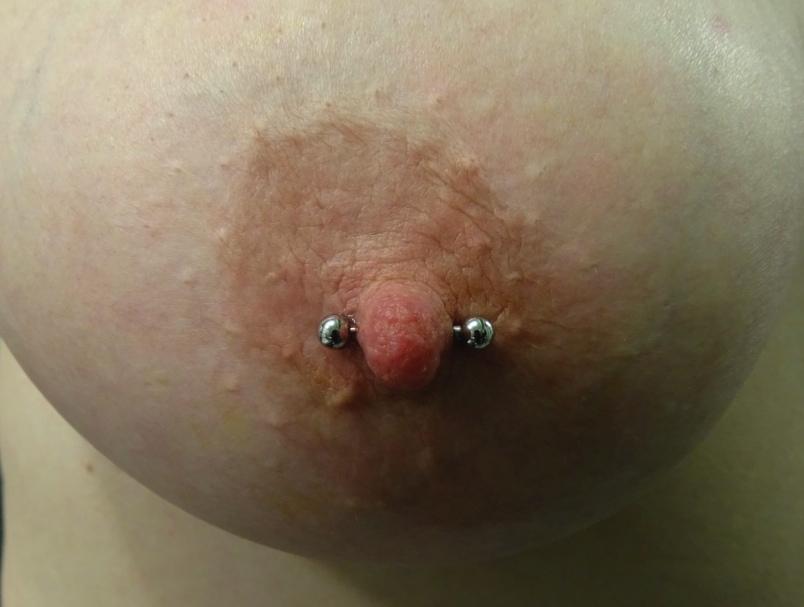 response to stimulation Piercing too wide