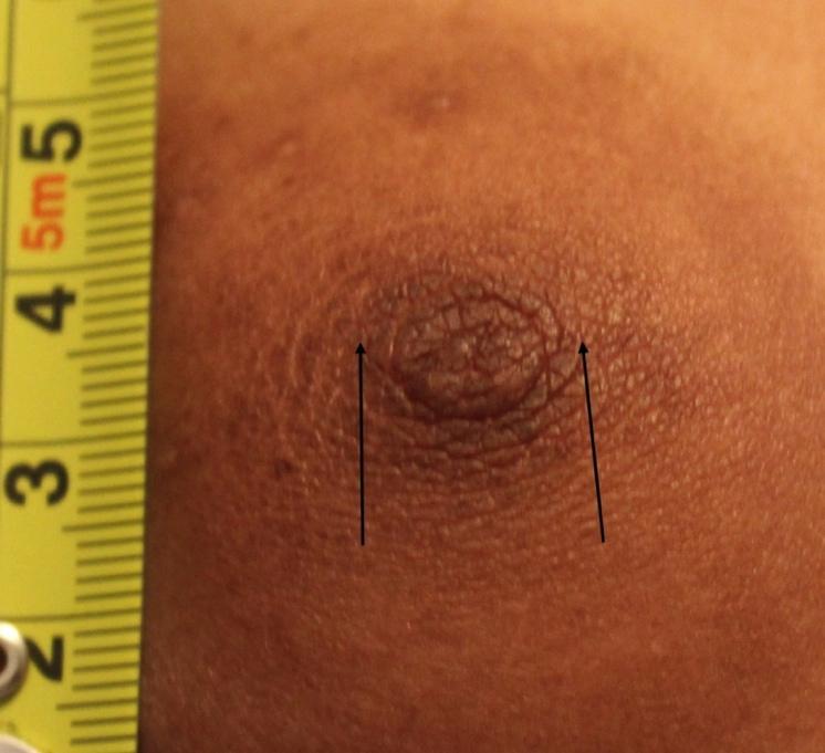 tissue On flat nipples, piercing should encompass