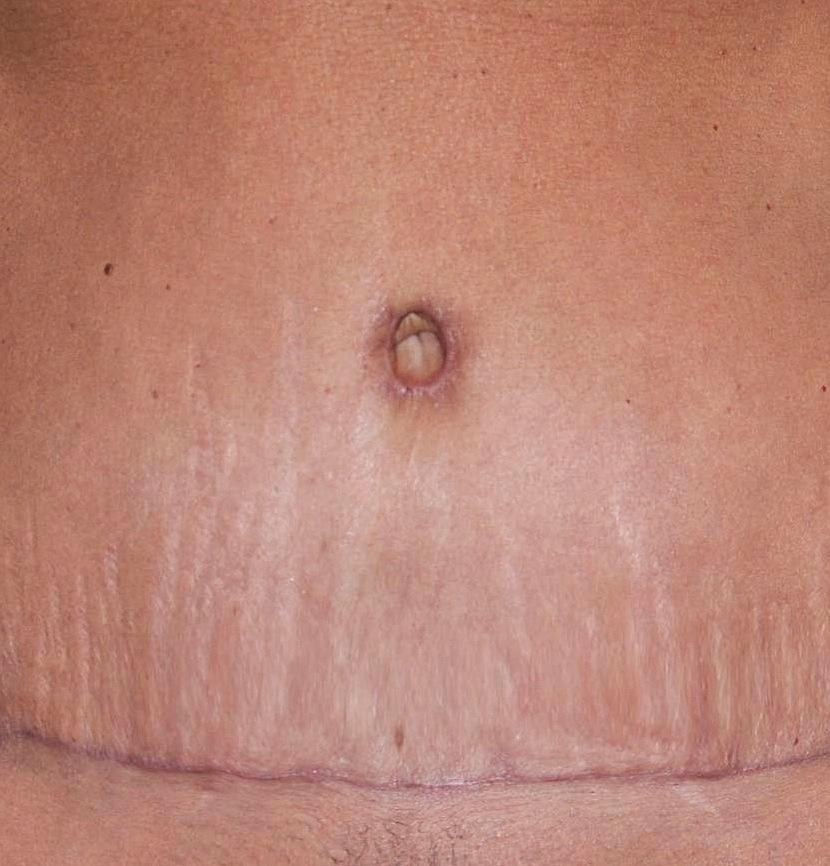 scar tissue not a good place for a piercing Laparoscopic scars of the
