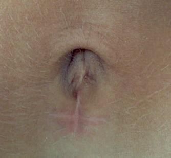 Ports are also commonly inserted near the exit side of a standard navel