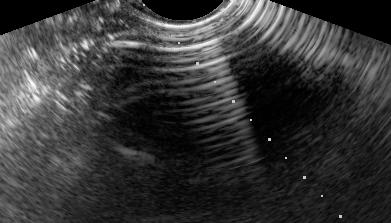 Artifacts in Ultrasound Reverberation Edging artifact Axial