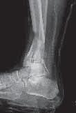 Two cases are presented as examples for discussion concerning closure of the open wound from a fracture.