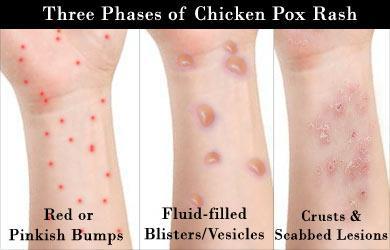 Chicken Pox Etiology: Varicella Virus Spread by direct contact or breathing in germs Most common in children but