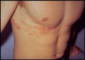 Shingles herpes zoster Etiology: 20% chance of contracting if had chicken pox S/S: Tx: Painful Inflammation that affects
