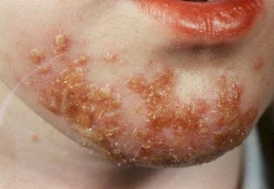 Impetigo Etiology: S/S: Tx: Staphylocicci or streptococci Spread from person to person through direct contact with discharge