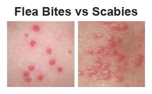 Scabies Etiology: Contagious skin eruption Caused by mites S/S: Tx: Occurs between