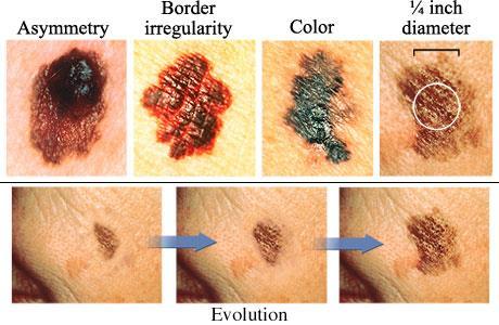 Skin Cancer Etiology: S/S: Tx: 3 types: Basal cell carcinoma, squamous cell, carcinoma, malignant melanoma More than 90% appear on sun exposed skin, usually face, neck, ears, forearms,