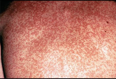 Rubella German Measles Etiology: Especially dangerous to pregnant women, can cause severe birth defects.