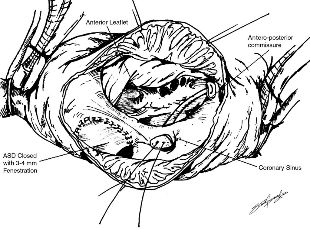 Management of neonatal Ebstein s anomaly 103 Figure 2 When the anterior leaflet is sail-like and free, and the annulus is very dilated ( 20 mm), a pledgetted suture is placed through the annulus at