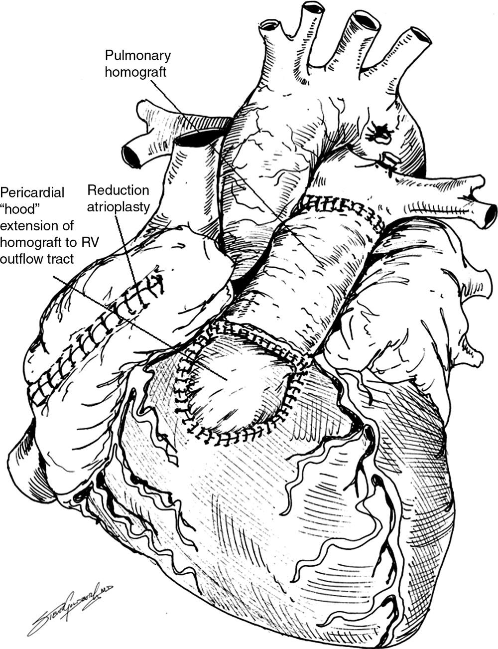 Management of neonatal Ebstein s anomaly 107 Figure 6 In the presence of anatomical pulmonary atresia, or in situations where the tricuspid valve repair is suboptimal or the branch