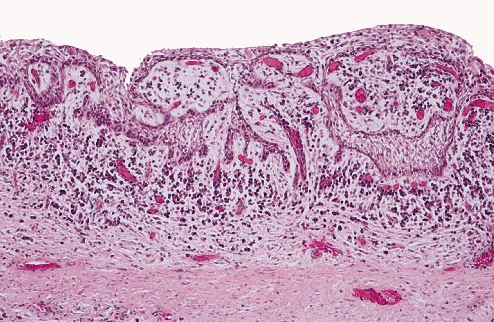 nonkeratinizing cells Interface (flat) Inflamed : Fibrous wall