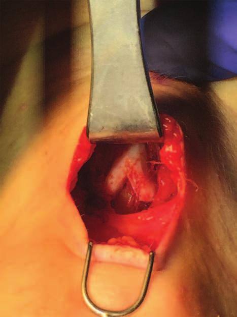 3 and 4). Depending on the height of the patient s native larynx, one may choose to either raise or lower the position of the graft to appear appropriate when viewed from profile.