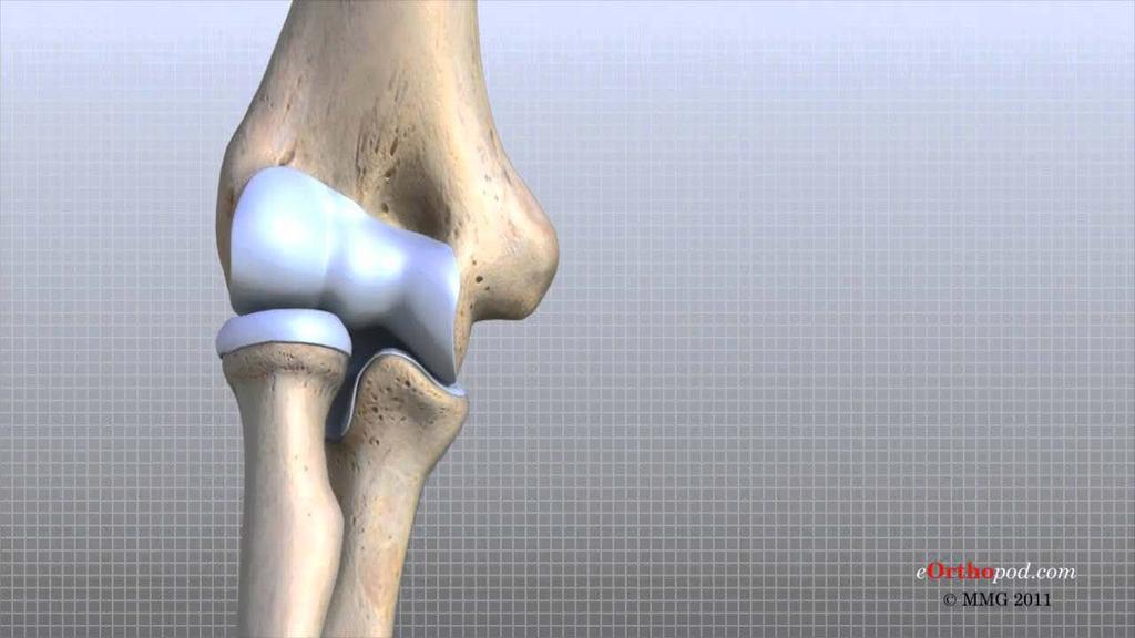 Elbow: DDX of pain generators Lateral Epicondylitis