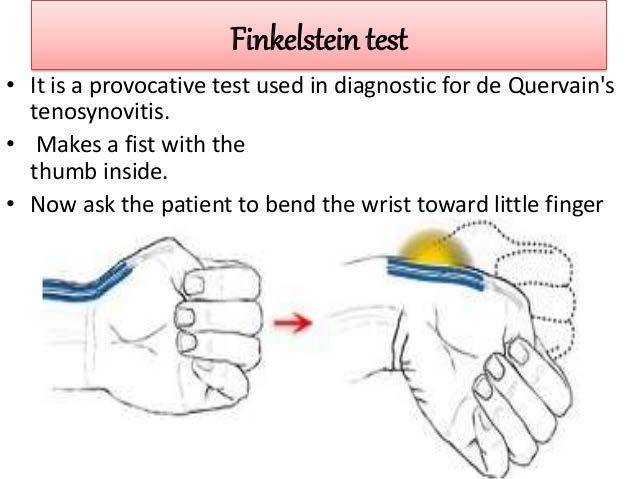 De Quervain tenosynovitis Mechanism: acute or chronic inflammation of the EPB & APL tendons against the radial styloid