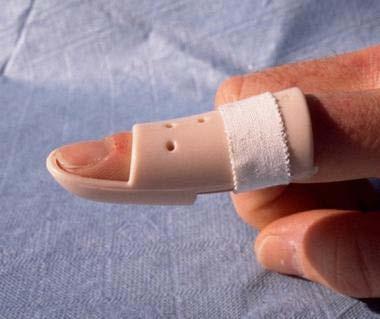 Exam: inability for the patient to actively extend the DIP joint of the affected finger