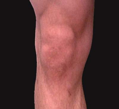 Knee: DDX pain generators IT band Ober test ACL/PCL Drawer tests LCL Varus stress test Patellofemoral