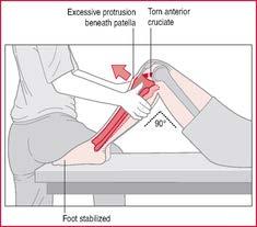 ACL tear Mechanism: most are noncontact injuries.