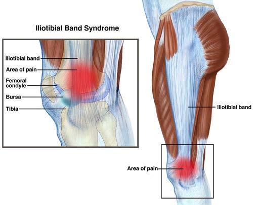 Iliotibial band friction syndrome Mechanism: a condition