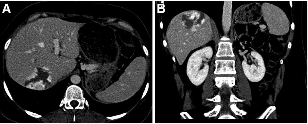 July 2011 BENIGN SOLID AND CYSTIC LESIONS OF THE LIVER 553 Figure 3. CT illustration of the characteristic enhancement features of liver hemangioma.